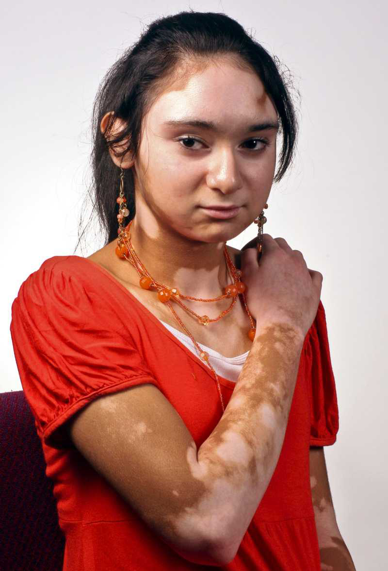 Treatment For Segmental Vitiligo : Vitiligo - Causes, Symptoms And Treatment
